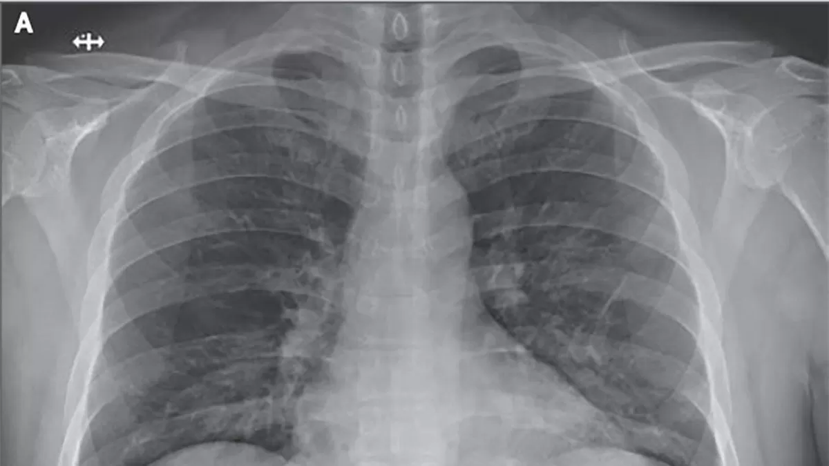 Cómo saber si hay daño pulmonar por covid