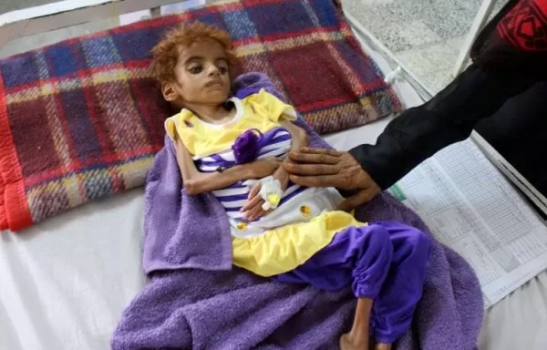 La desesperación de los médicos ante el hambre de los niños en Yemen
