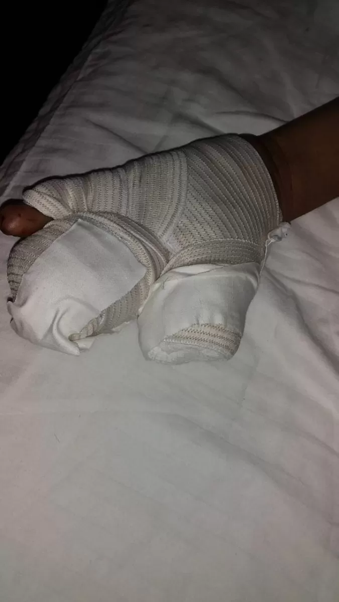 Menor pierde dos dedos por manipular pólvora en Choluteca