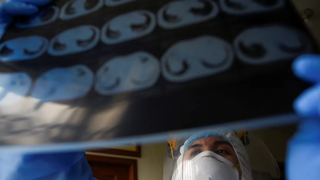 Médicos realizan el primer trasplante doble de pulmón a un paciente que contrajo covid-19