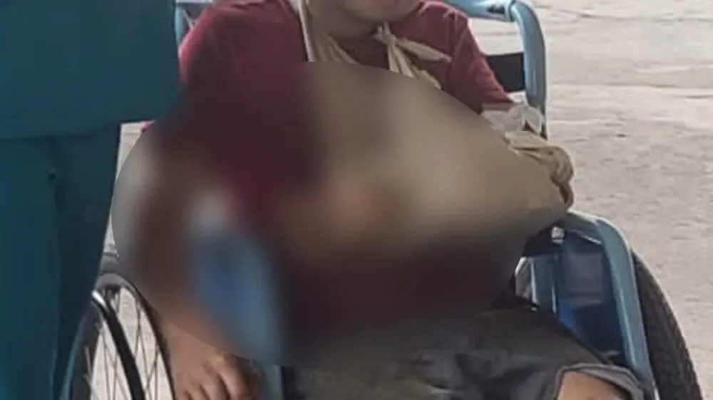 Menor de edad sufre heridas en su brazo y su pierna en un taller de soldadura en la Entrada, Copán