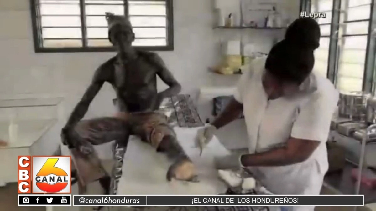 SESAL Confirma 13 casos de lepra en menores, en el departamento de Choluteca